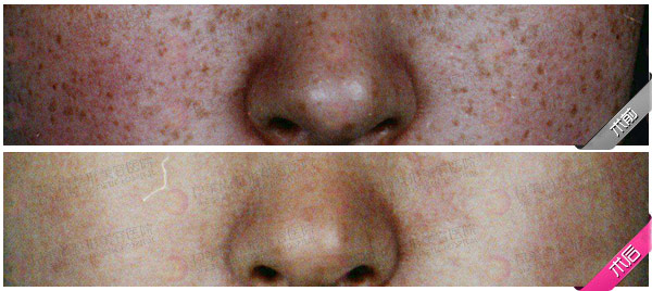 飛梭年輕化系統(tǒng)嫩膚手術(shù)效果圖