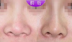 膨體隆鼻手術(shù)成功案例