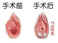 處女膜修補術成功案例