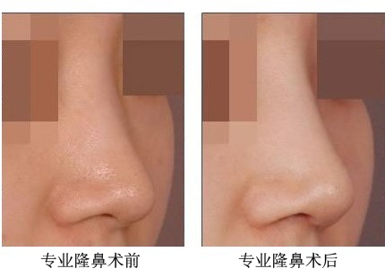 專業(yè)隆鼻術(shù)的成功案例