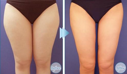 WA臻景體型雕塑的成功案例