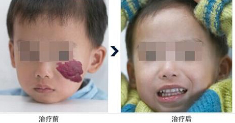 激光治疗血管瘤