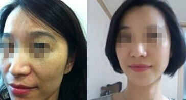 第三代热玛吉成功的真实案例