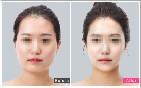口述韩式微创改脸型的真实案例