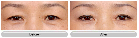 眼瞼下垂矯正效果圖