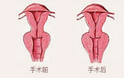 陰道緊縮真人案例