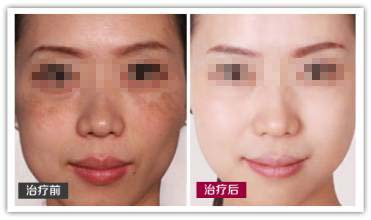 口述祛斑美肤全效管理的真实案例