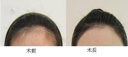 發(fā)際線脫毛效果圖