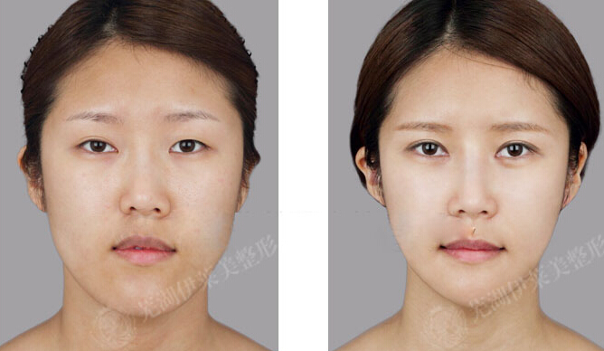 芜湖伊莱美整形医院颌面整形案例