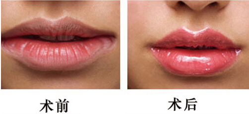 紋唇效果圖