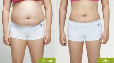 水動(dòng)力安全吸脂的成功案例