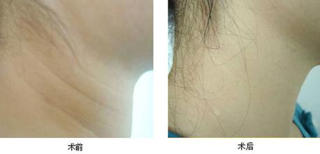 口述射頻除皺的真實案例