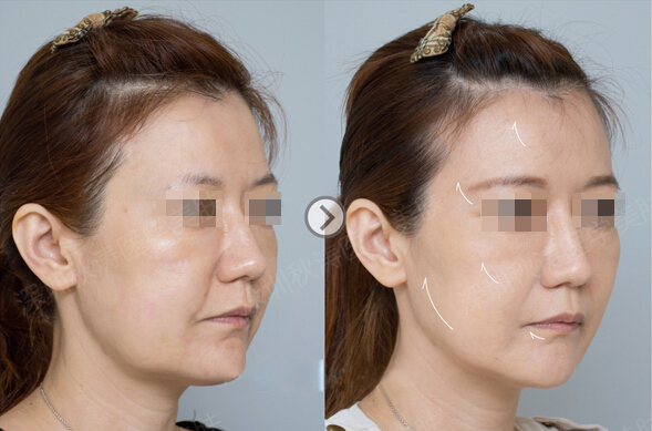 音波拉皮手术的成功案例