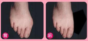 拇外翻矯正效果圖