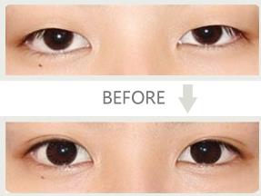 微創(chuàng)無痕美顏眼術(shù)的成功案例