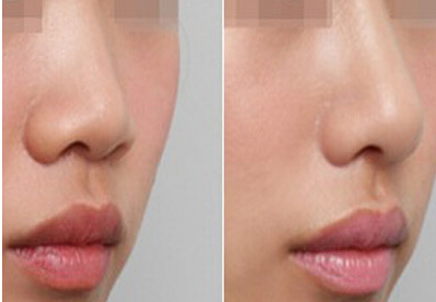 艷冠1型隆鼻效果圖