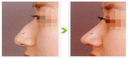 駝峰鼻矯正手術(shù)的成功案例