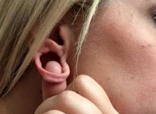 美女子不堪耳洞過大上真人秀求助整形醫(yī)生