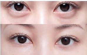 面部輪廓手術(shù)無痕祛眼袋真實案例