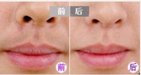 武漢SKV綠光脫毛技術成功案例