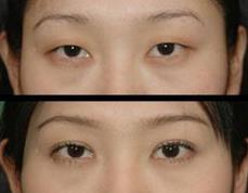 無(wú)痕魅力電眼的真實(shí)案例