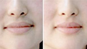 激光脫毛的成功案例