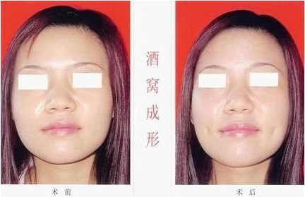潍坊华美人造酒窝成形术成功案例