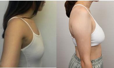 自體脂肪豐胸成功案例