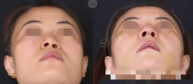 隆鼻失败修复术成功案例