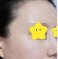 杭州维多利亚医疗脂肪填充太阳穴真实案例