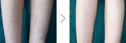 冰點脫毛成功案例