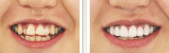 牙齒整形成功案例