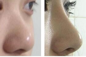 定制隆鼻成功案例