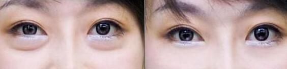 三維綜合祛眼袋成功案例