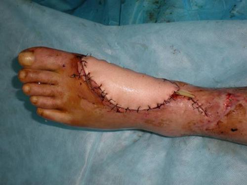 深圳南方门诊皮瓣移植，皮瓣移植术拯救了左小腿