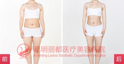 360°柔性吸脂成功案例