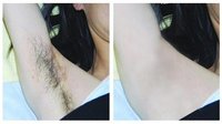 脱腋毛成功案例
