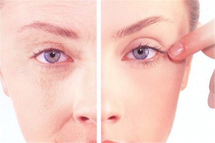 沈阳杏林注射除皱有哪些方法呢