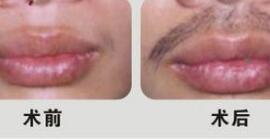 胡須種植成功案例