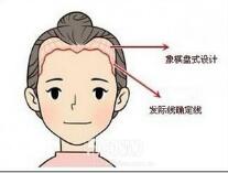 济南美容整形医院发际线种植的效果如何