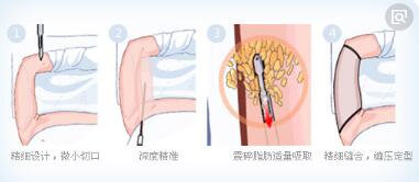 �ֱ���֬�g(sh��)���Ա�����ʹ��