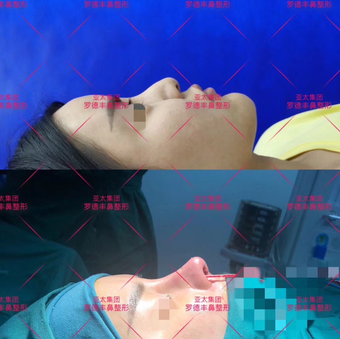 公司職員體驗(yàn)隆鼻手術(shù)術(shù)后心得分享