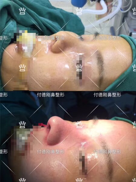 體驗隆鼻,給我一個完美的鼻子