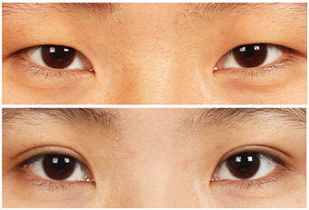 埋線雙眼皮成功案例