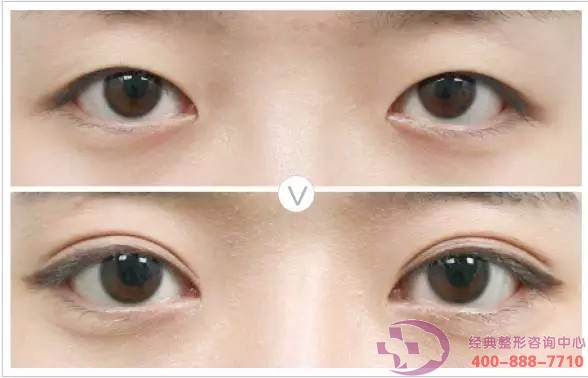 面部輪廓手術美睫重瞼術成功案例