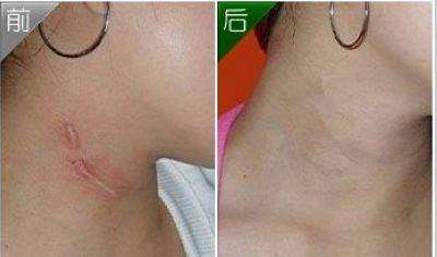 注射疤痕軟化針適合這兩種人