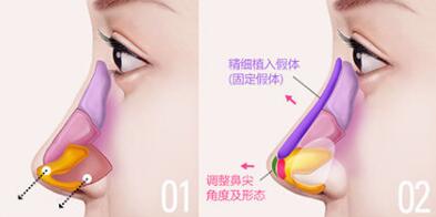 自体脂肪注射隆鼻是所有隆鼻材料中很好的一种吗