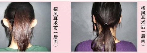 招风耳矫正手术会不会很痛