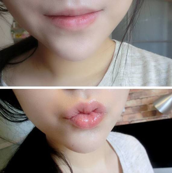 山东聊城薄唇增厚一般的价格是多少