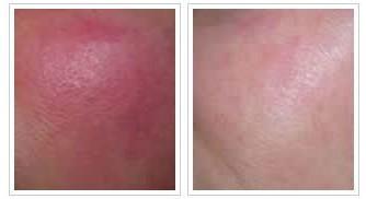 ����ȥ�tѪ�zЧ���ܾS�ֶ��